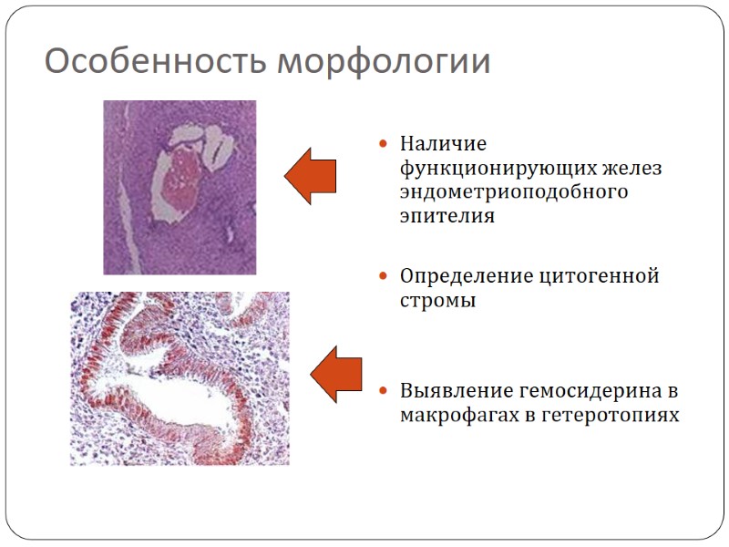 Особенность морфологии Наличие функционирующих желез эндометриоподобного эпителия  Определение цитогенной стромы   Выявление